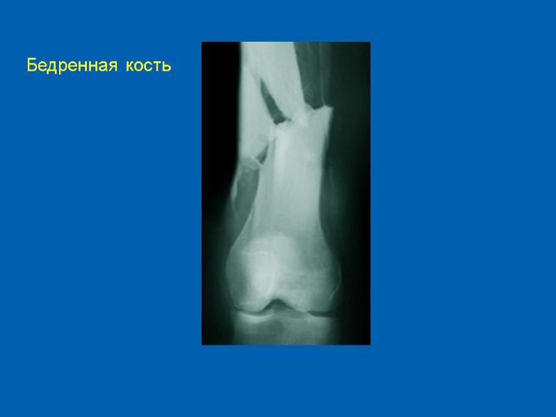 Бедренная кость